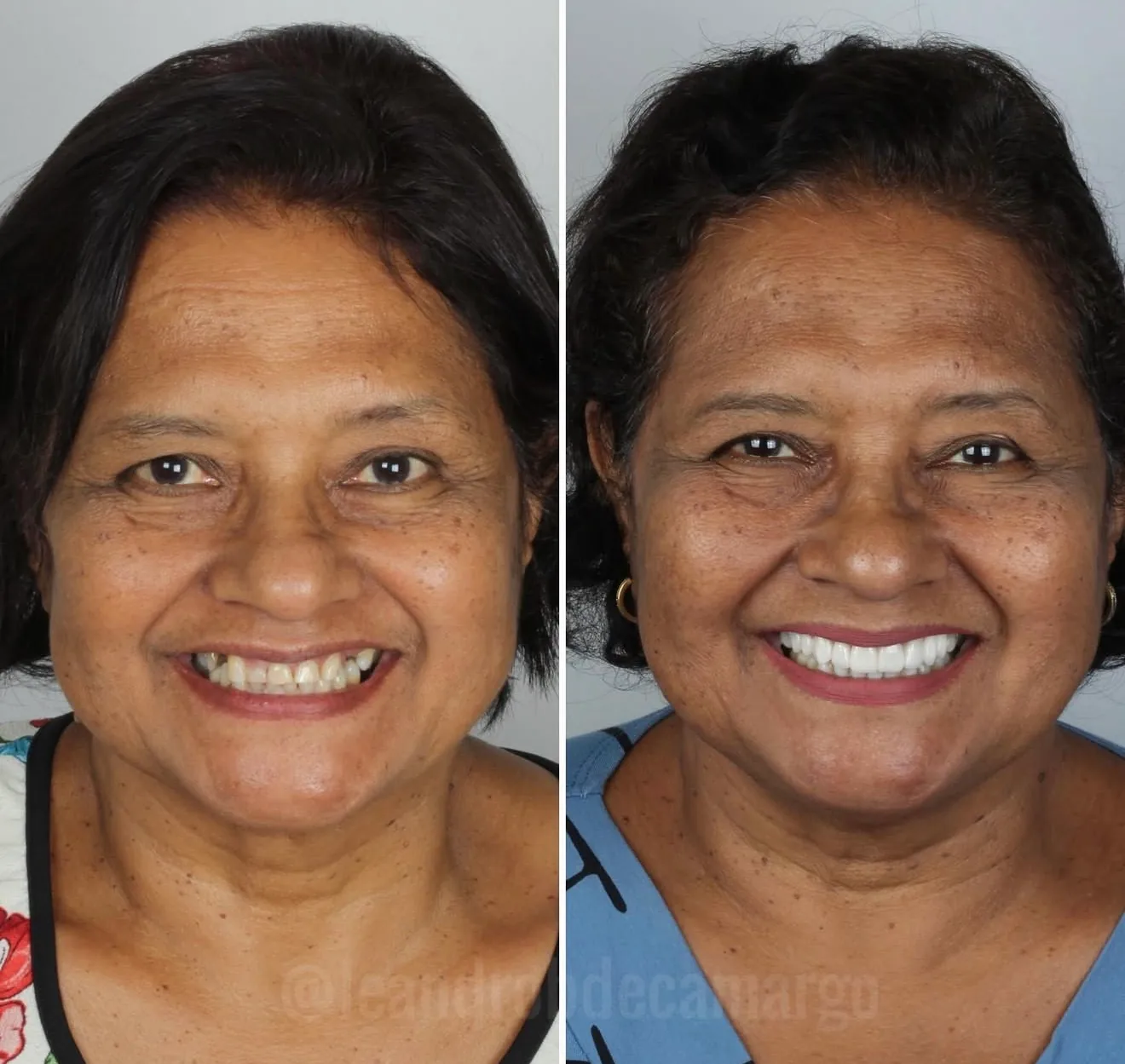 antes-e-depois-clareamento-dental-campo-grande-ms
