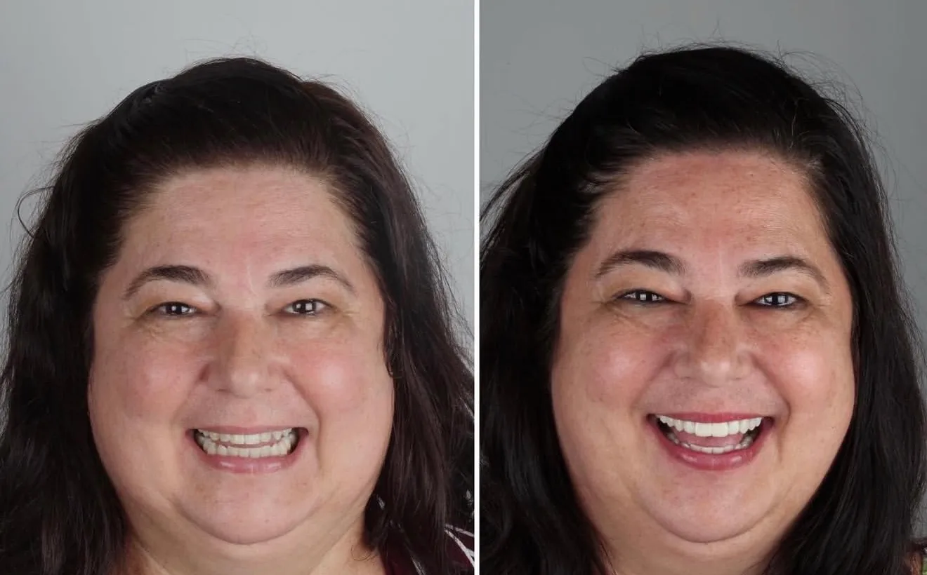 antes-e-depois-dentista-campo-grande-ms