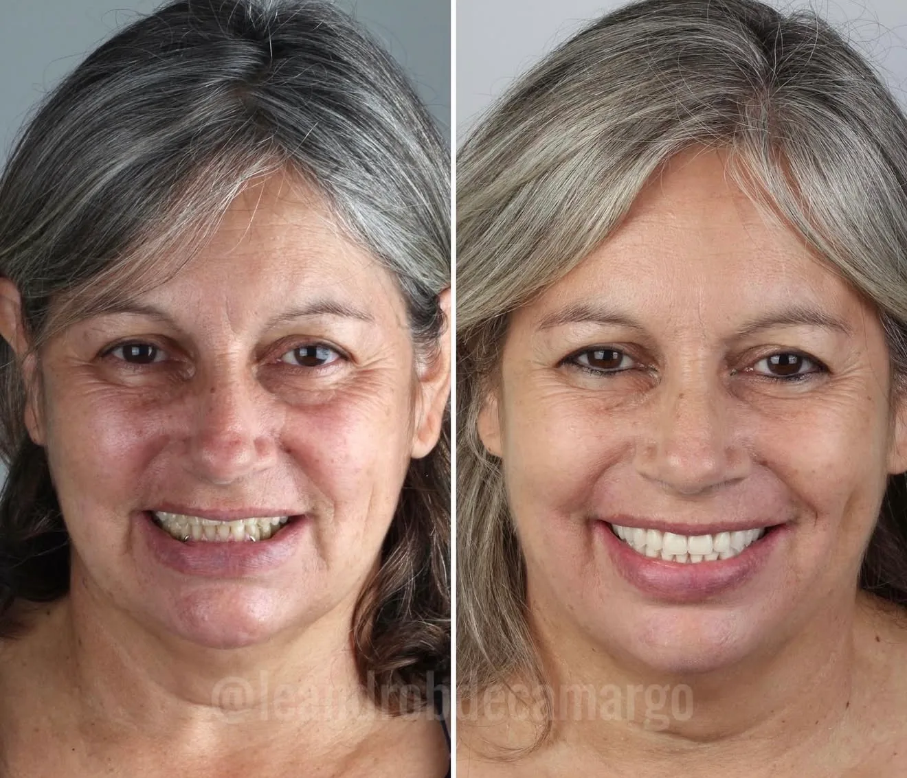 antes-e-depois-faceta-dental-campo-grande-ms