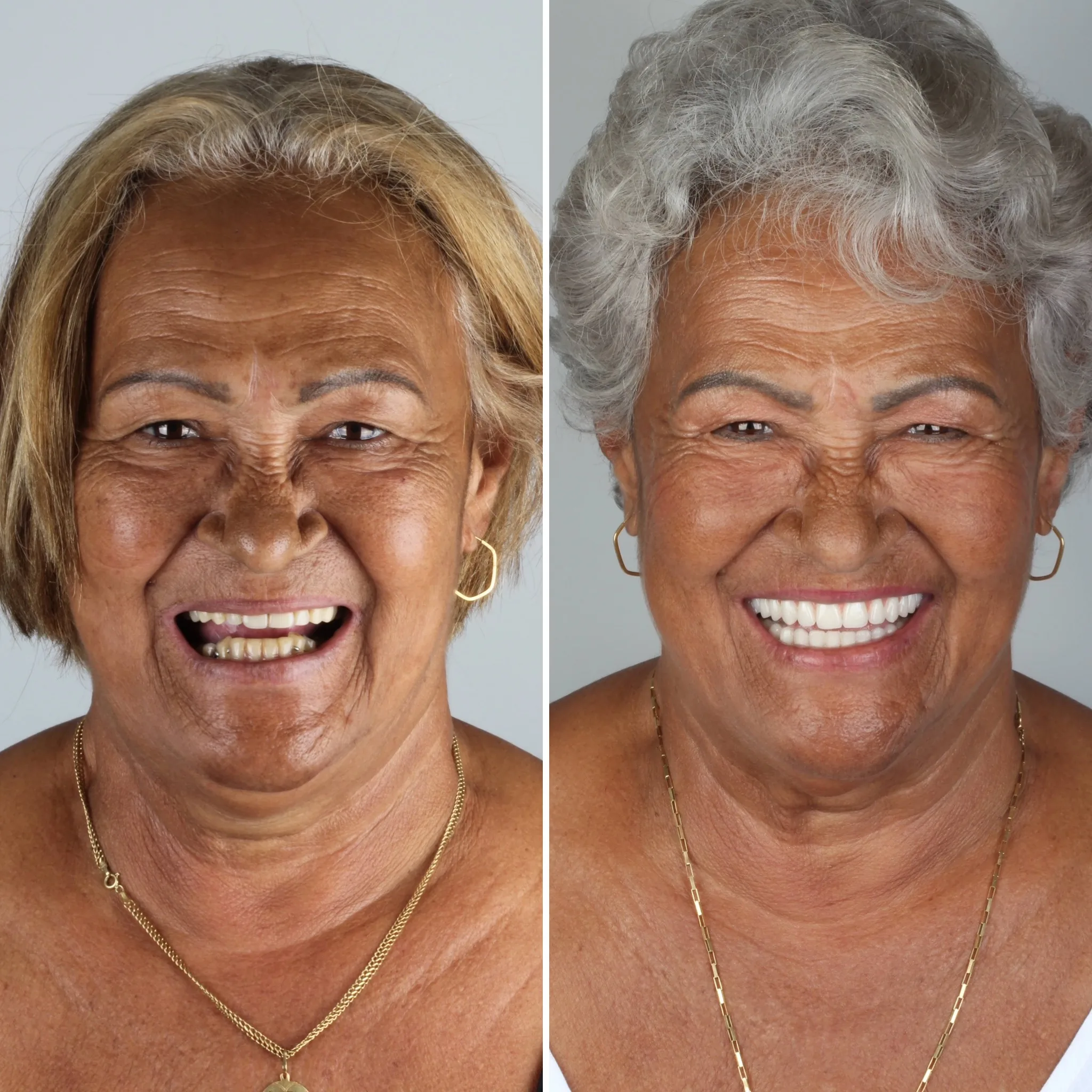 antes-e-depois-implante-dentario-campo-grande-ms
