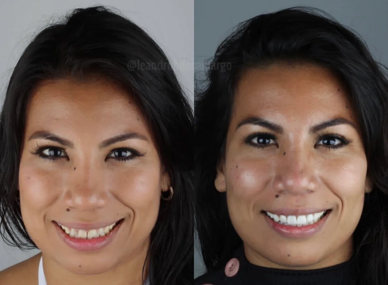 antes-e-depois-protese-dentaria-campo-grande-ms