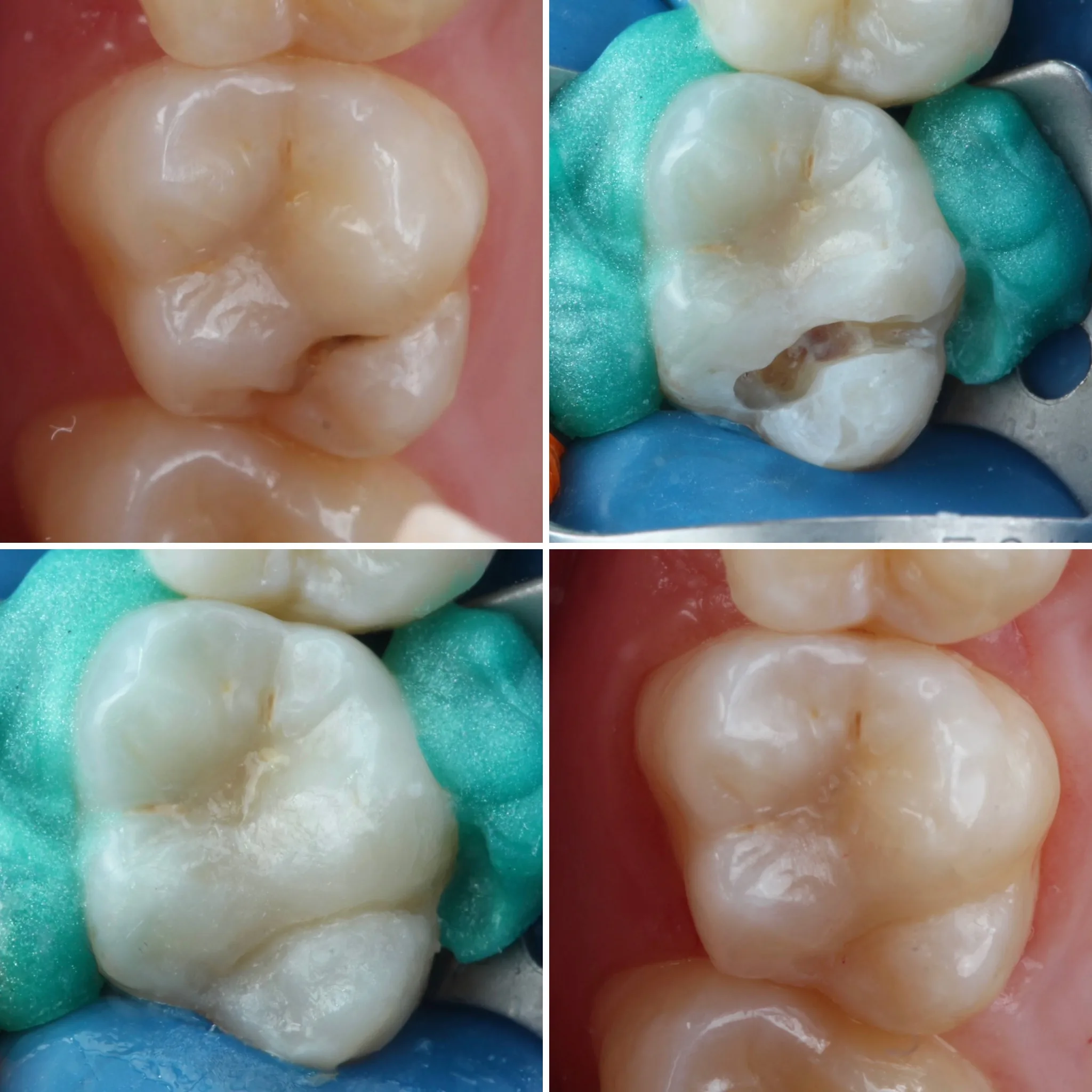 clareamento-dental-campo-grande-ms