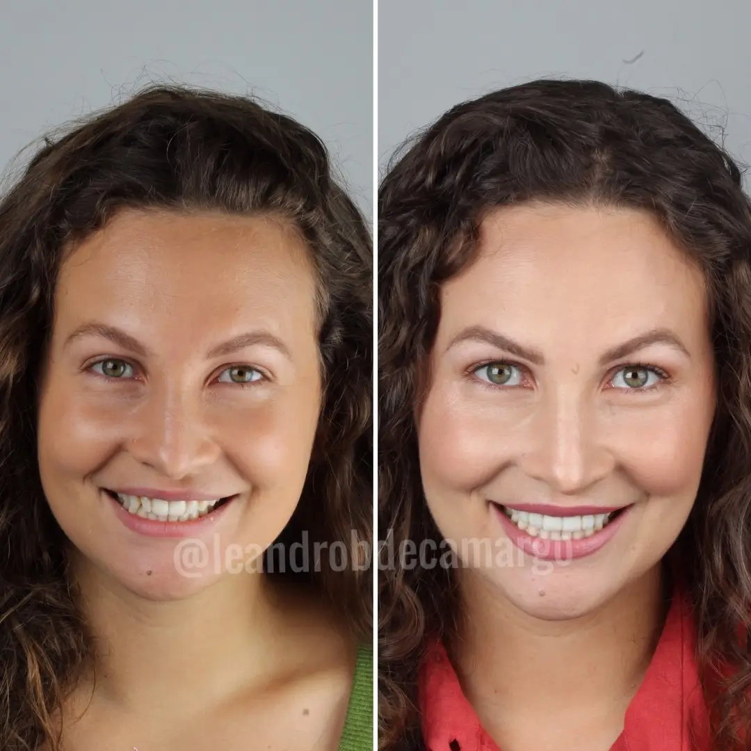 clareamento dentário dentista campo grande ms