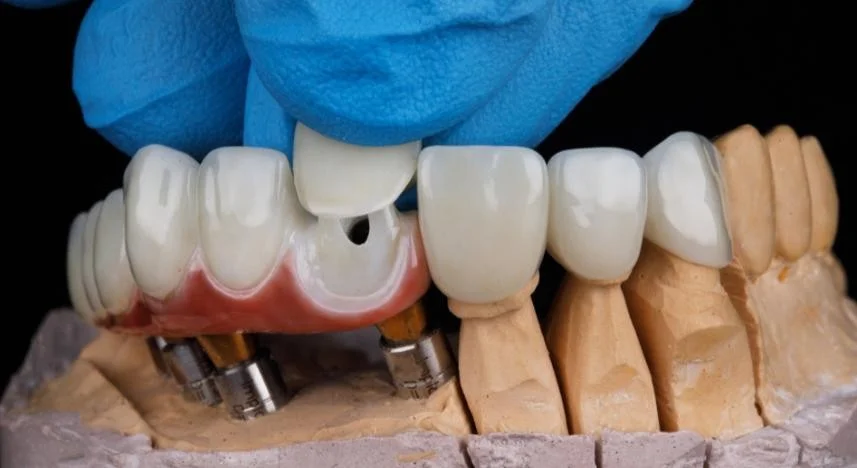 Coroa em cerâmica — Clínica Inovare Odontologia, Campo Grande MS