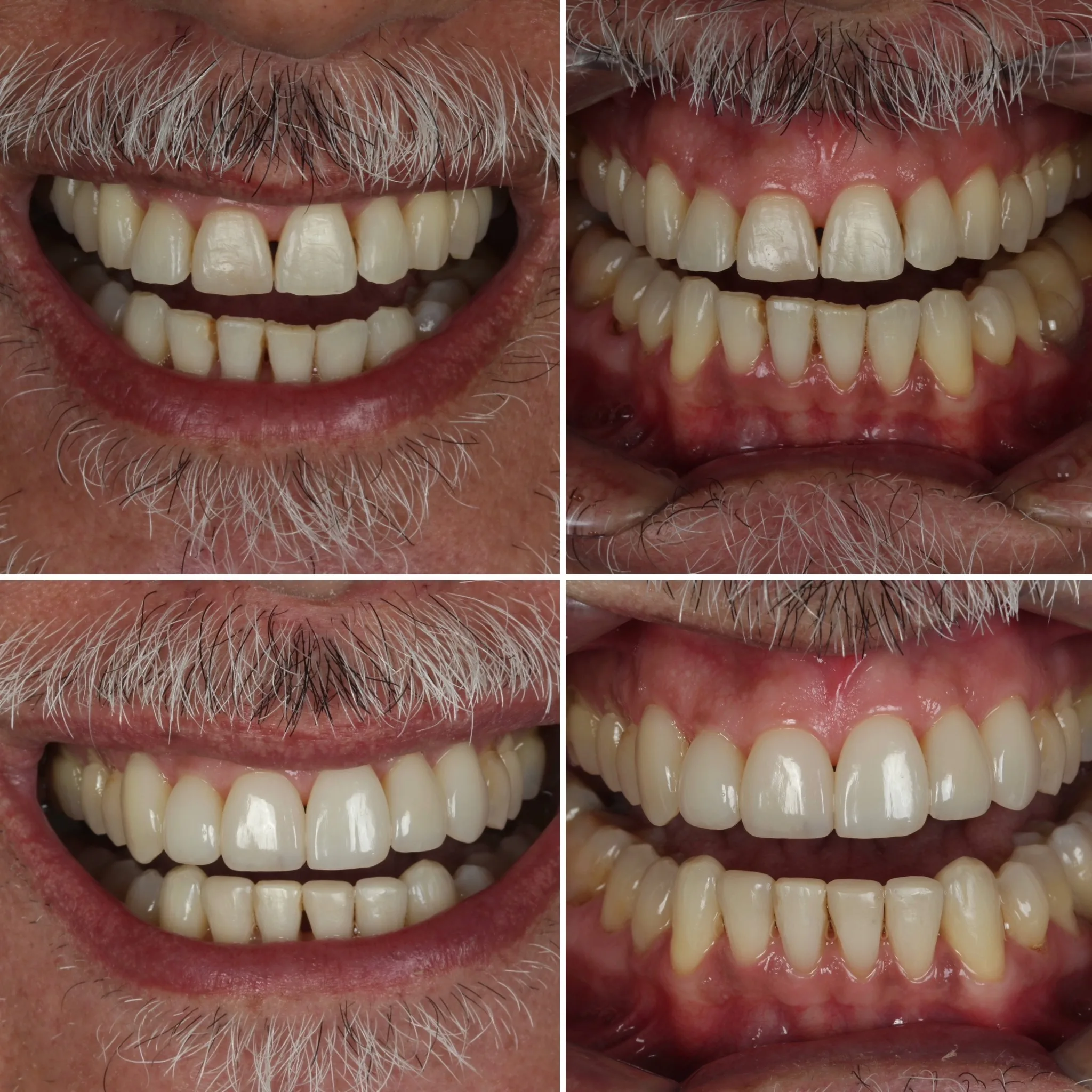 dentista-especialista-em-facetas-campo-grande-ms