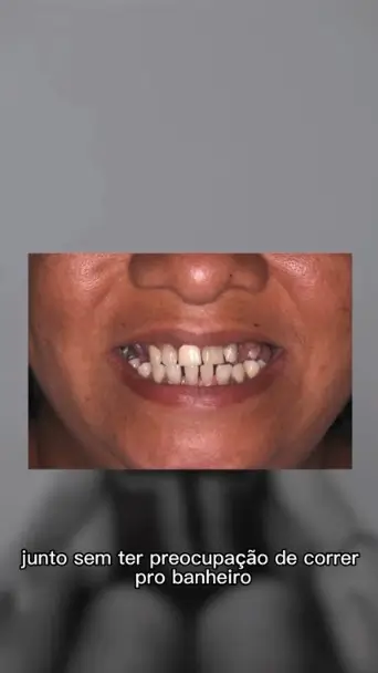 dentista implante dentário