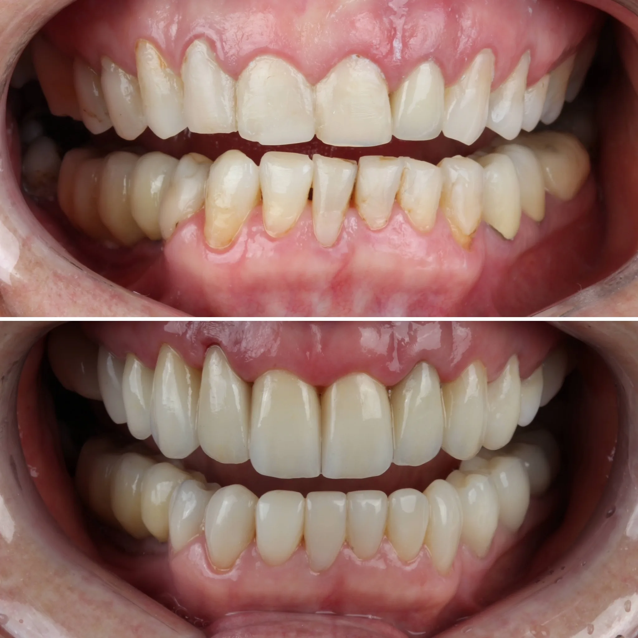 dentista prótese parcial removível