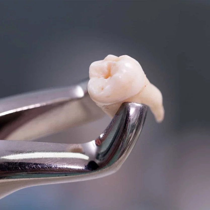 Extração de dente do siso — Clínica Inovare Odontologia, Campo Grande MS