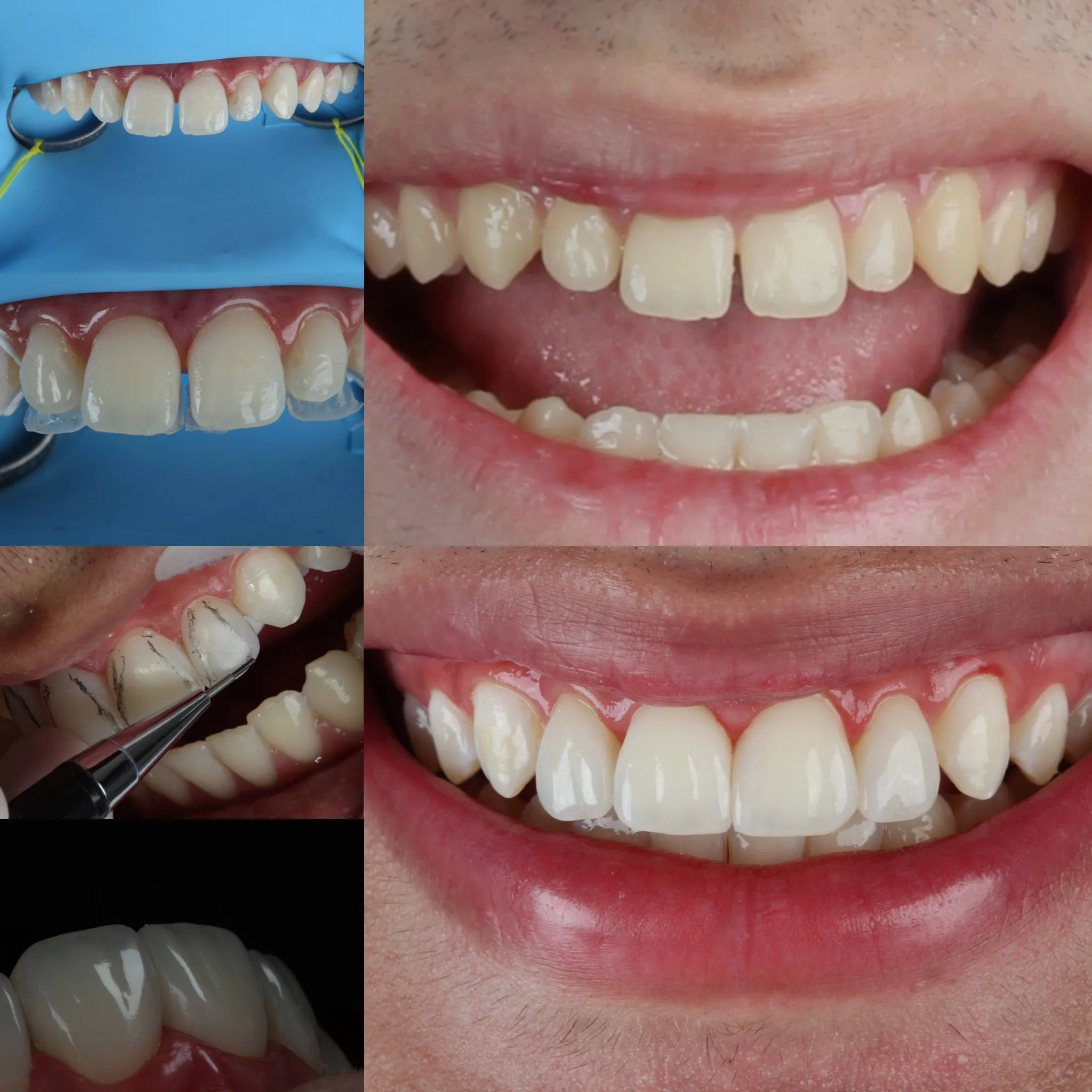 faceta-dental-campo-grande-ms