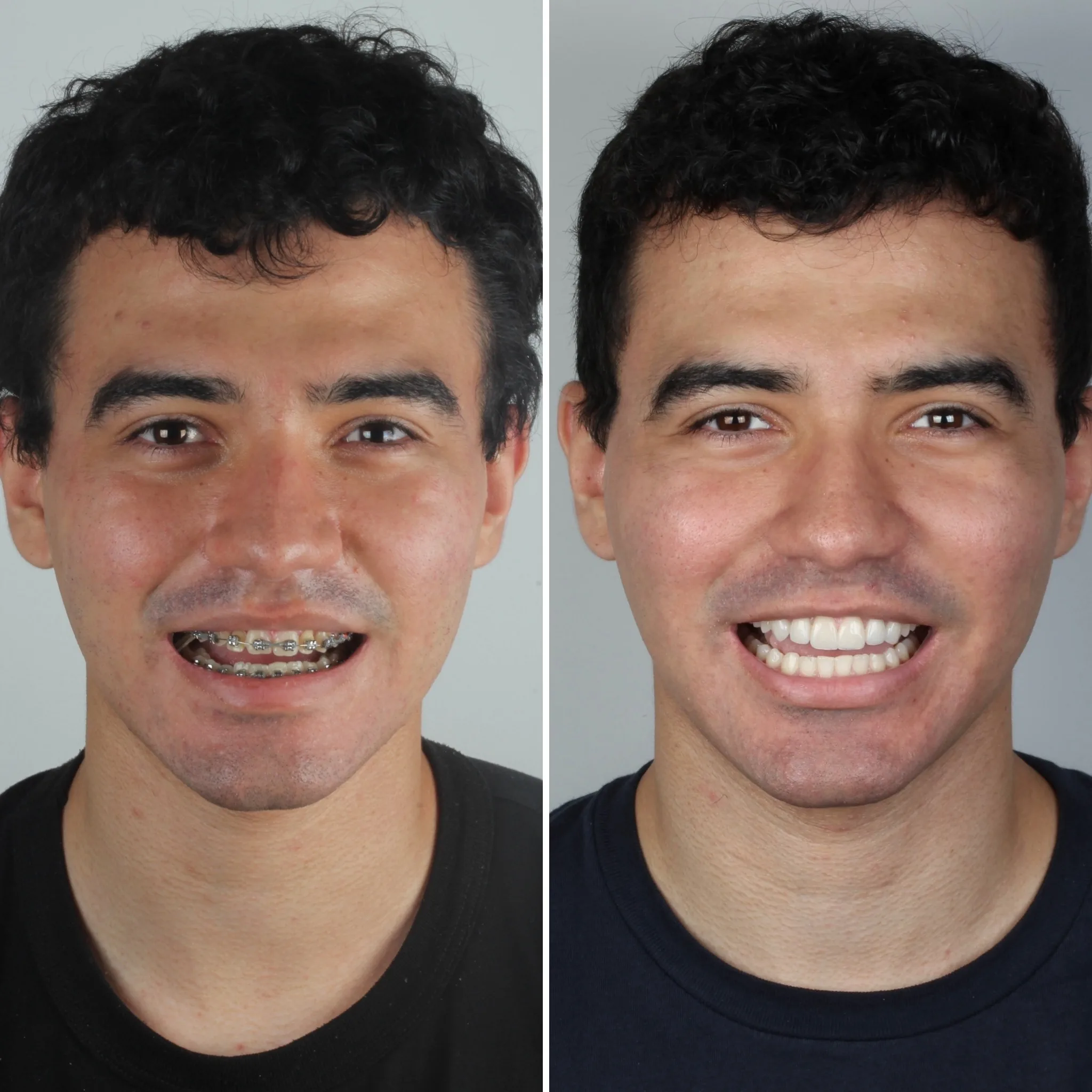 harmonizacao-do-sorriso-campo-grande-ms