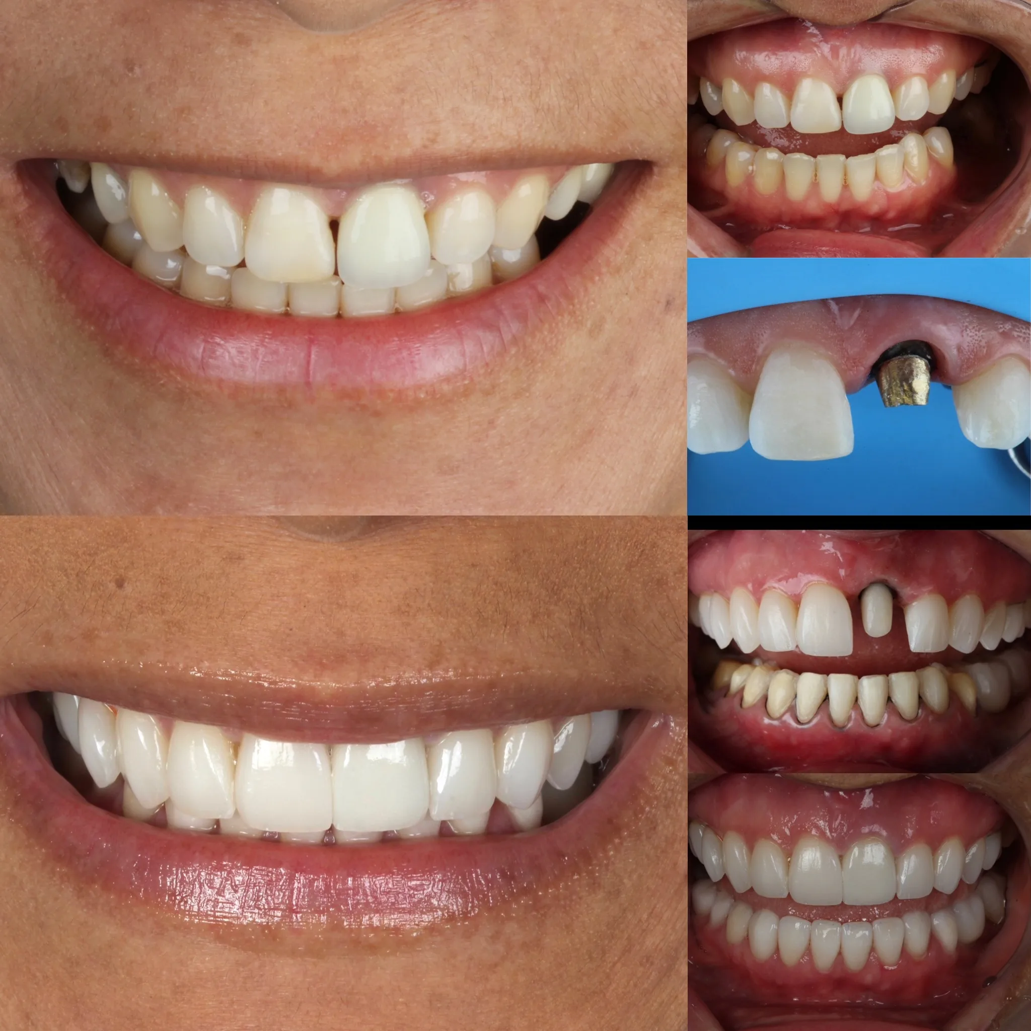 lente-de-contato-dental-campo-grande-ms