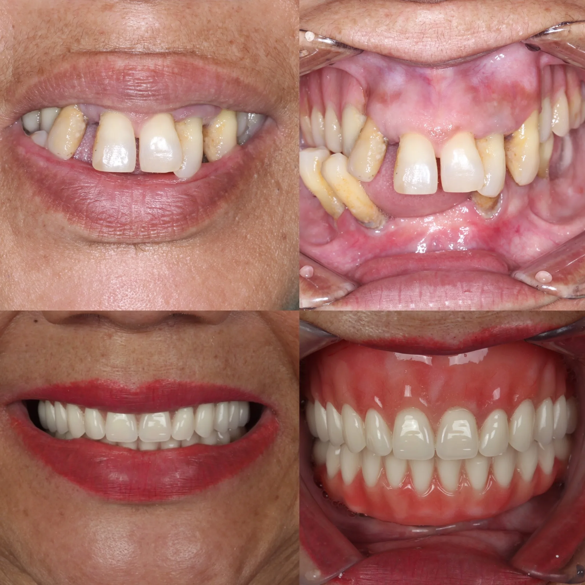 protocolo-dentario-antes-e-depois-campo-grande-ms