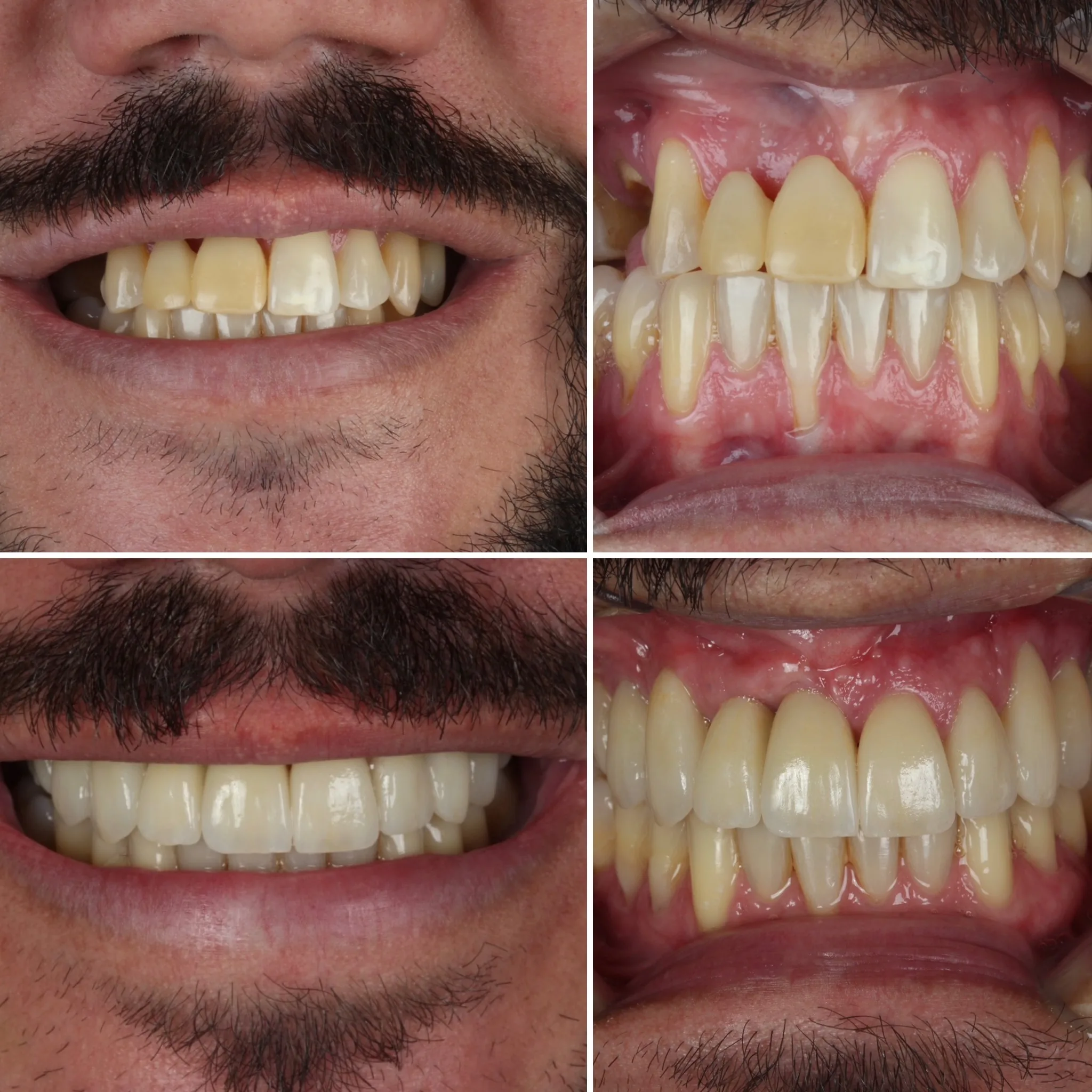 reabilitacao-oral-antes-e-depois-campo-grande-ms