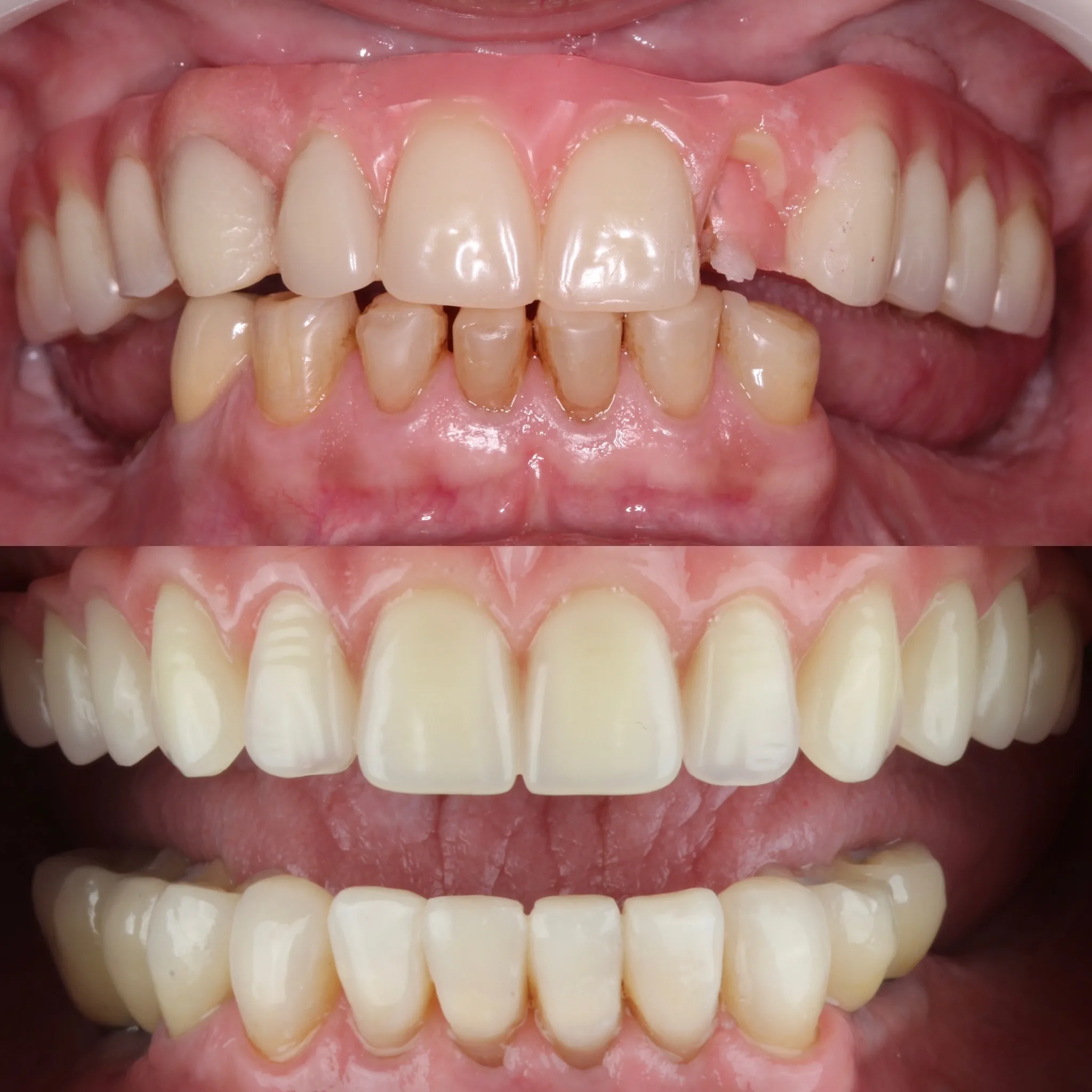 reabilitacao-oral-com-implante-campo-grande-ms