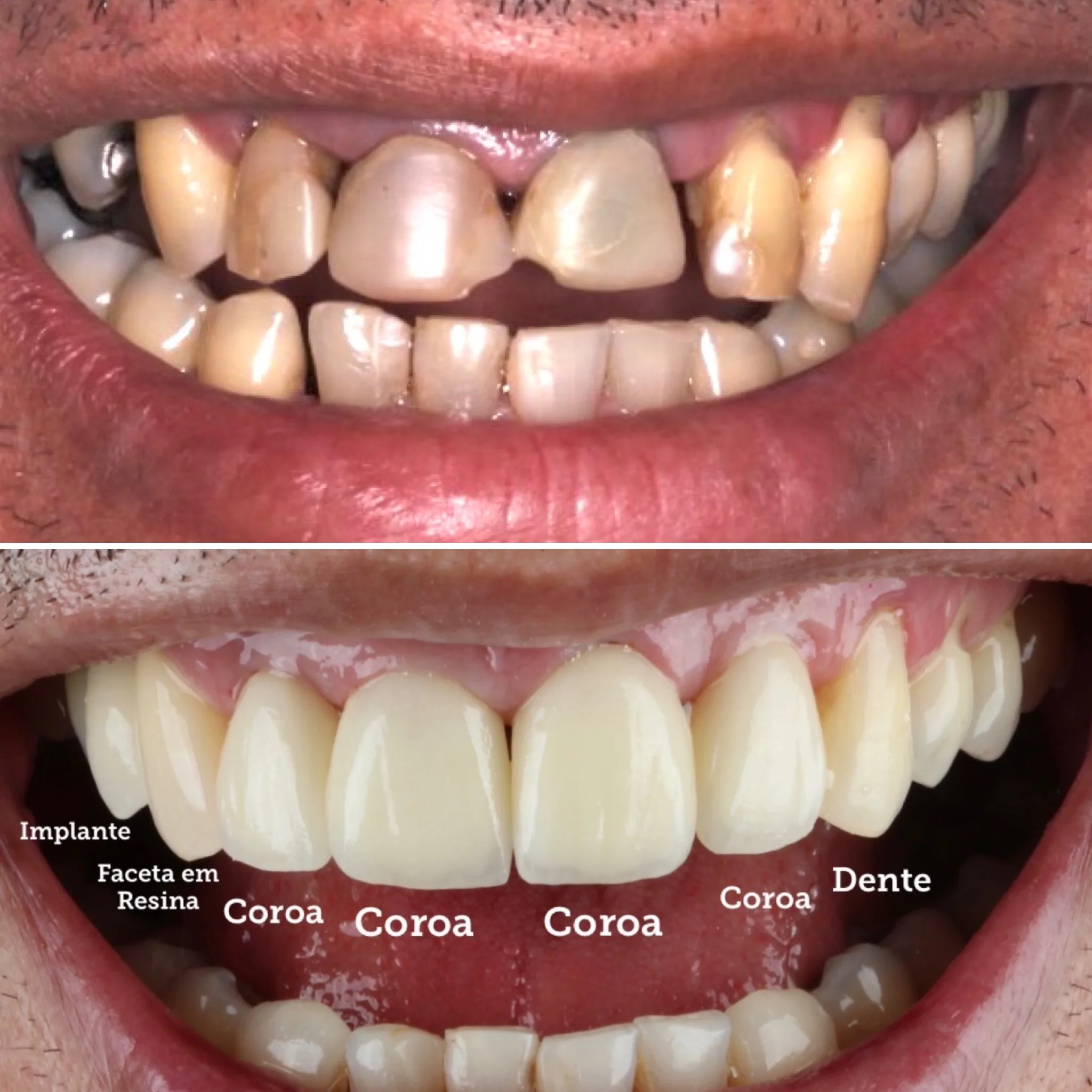 dentista prótese parcial