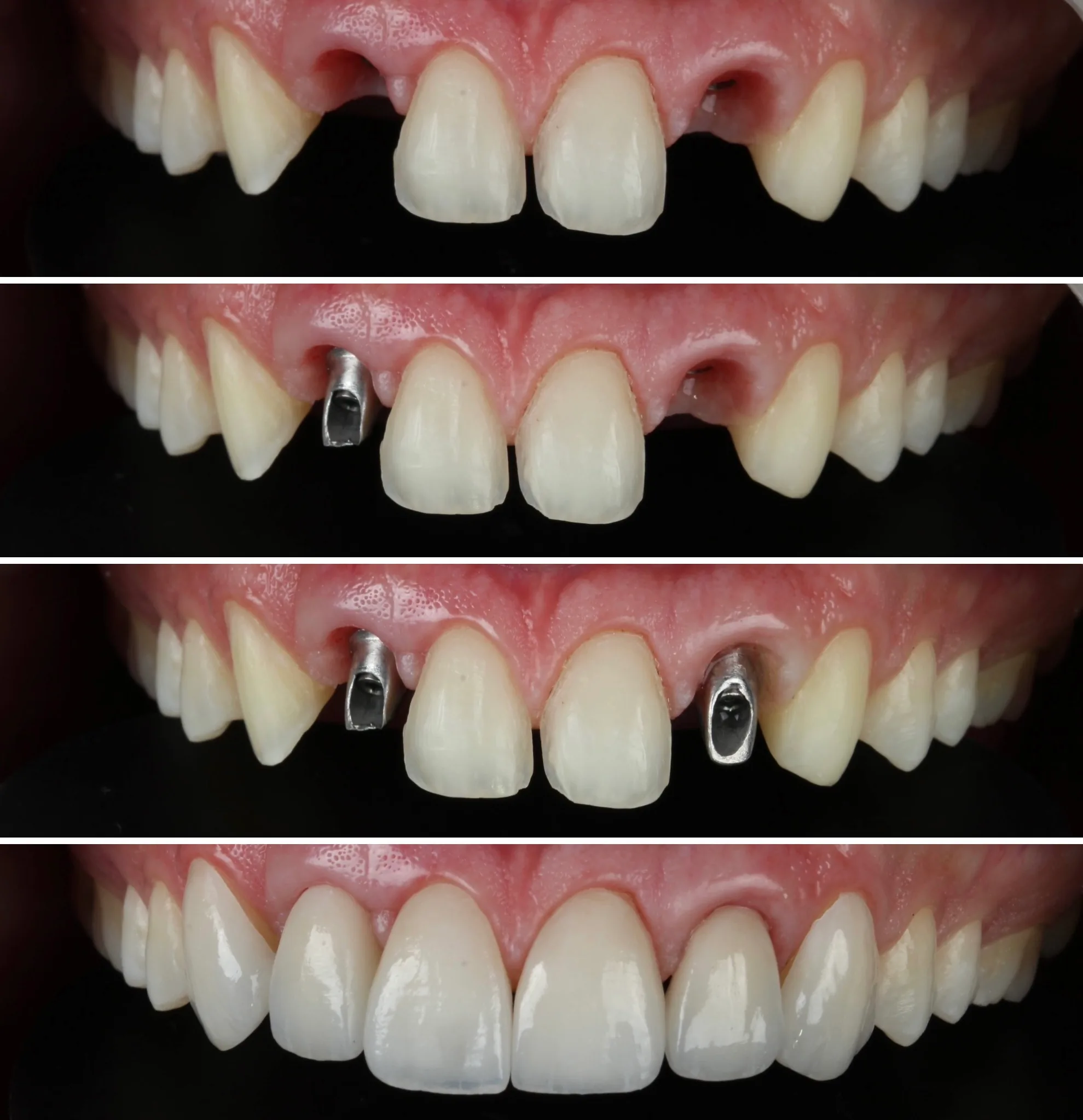 prótese dentária parcial removível valor