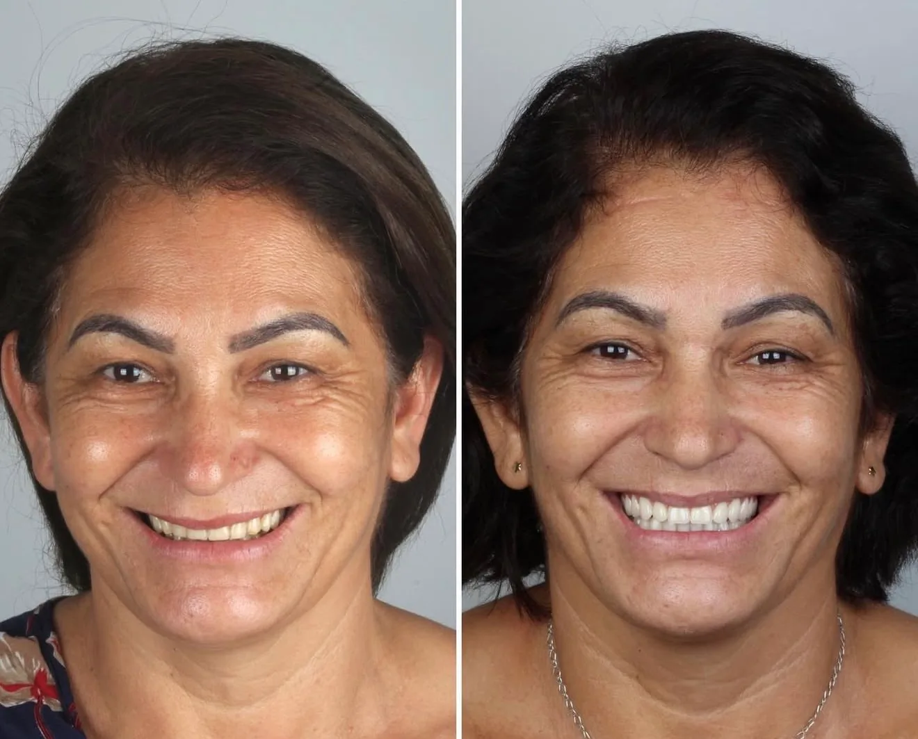 transformacao-do-sorriso-campo-grande-ms