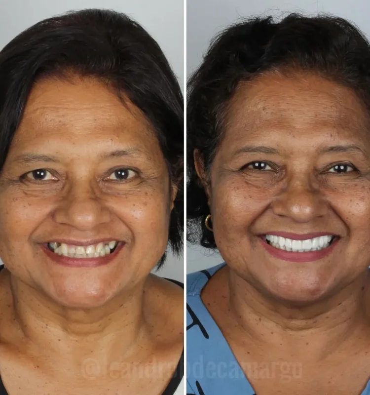 antes-e-depois-clareamento-dental-campo-grande-ms