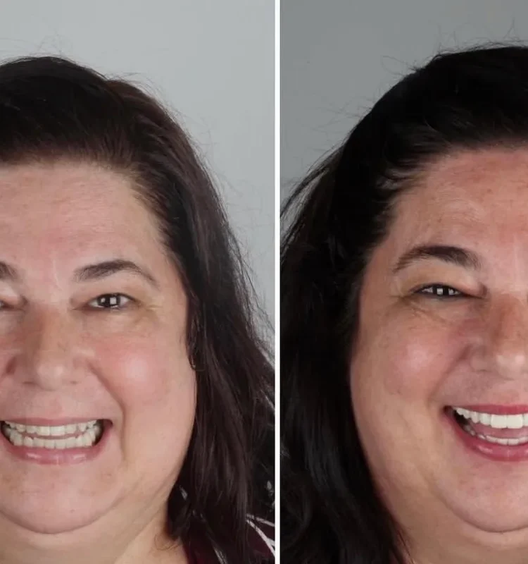 antes-e-depois-dentista-campo-grande-ms