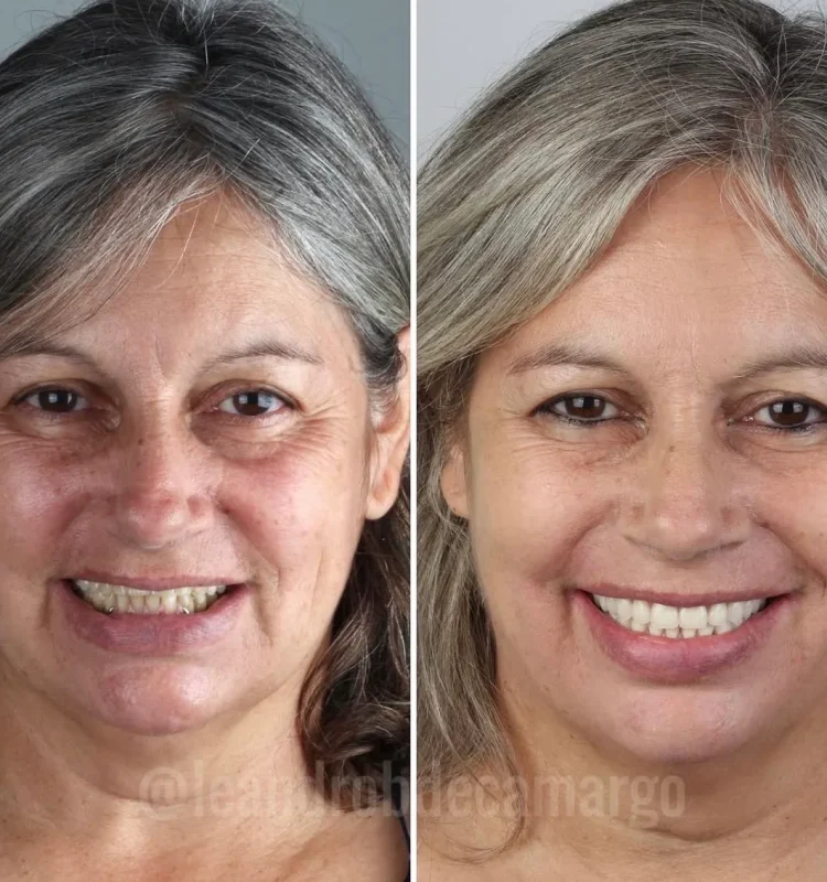 antes-e-depois-faceta-dental-campo-grande-ms