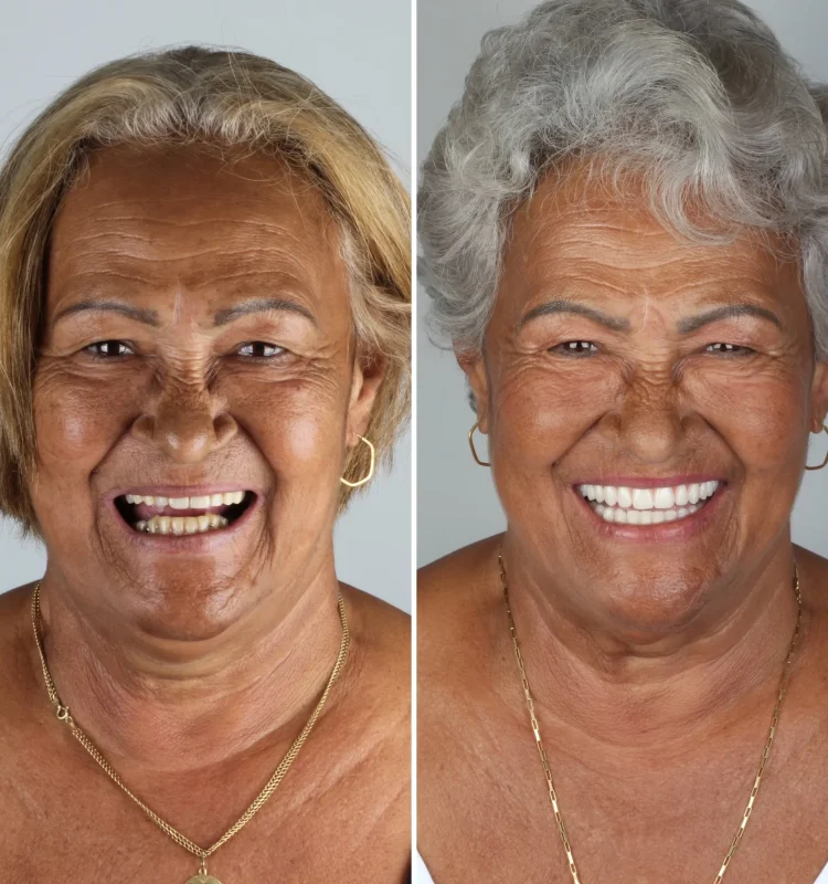 antes-e-depois-implante-dentario-campo-grande-ms