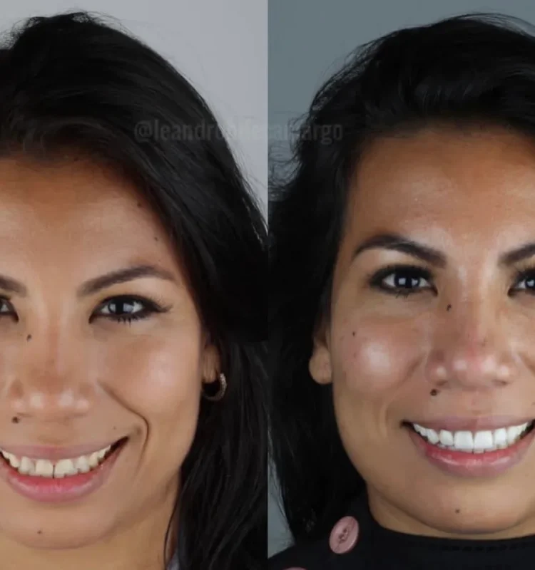 antes-e-depois-protese-dentaria-campo-grande-ms