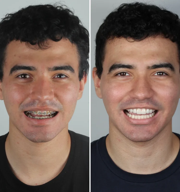 harmonizacao-do-sorriso-campo-grande-ms