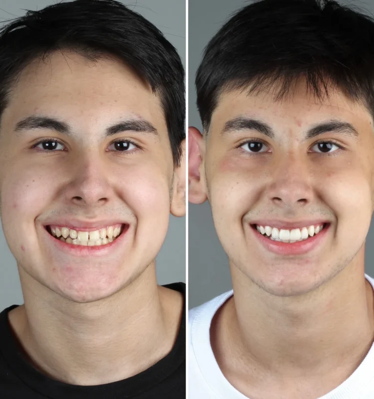 reabilitacao-completa-do-sorriso-campo-grande-ms